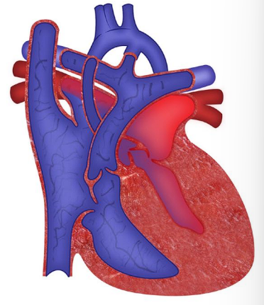 __**● Defect:**__  

○ Left-sided structures don’t develop normally  

○ Aorta is small  

○ Left atria/ventricle are hypoplastic 

○ Mitral valve is atretic  

○ When the ductus arteriosus closes, very little blood  will be able to get out to the body 

__**● History:**__  

○ Cyanosis when DA closes  

○ Increased RR, fatigue - Can lead to obstructive  cardiogenic shock  

__**● Specific assessment findings:**__ 

○ Hepatomegaly  

○ Murmur  