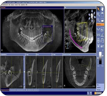<p>Cone Beam Computed Tomography (CBCT):</p><ul><li><p>A 3D imaging technique using a cone-shaped X-ray beam and a digital detector that rotates around the patient.</p></li><li><p>Produces detailed three-dimensional images of teeth, bone, and surrounding structures.</p></li></ul><p>Used for:</p><ul><li><p>Implant planning</p></li><li><p>Endodontic assessment (root morphology, resorption, fractures)</p></li><li><p>Orthodontic evaluation</p></li><li><p>TMJ and airway analysis</p></li><li><p>Pathology detection</p></li></ul><p>Advantages:</p><ul><li><p>Lower radiation dose than medical CT.</p></li><li><p>High-resolution, accurate spatial representation.</p></li><li><p>Allows precise measurements and cross-sectional views.</p></li></ul><p></p>