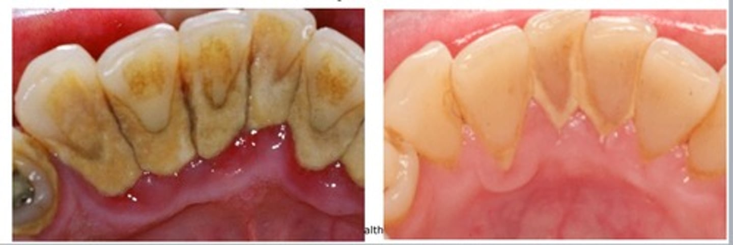 <p>hardened plaque that remains on teeth</p>