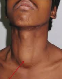 <p>implantation of thymic tissue during embryonic descent</p><p>usually midline, angle of mandible to midline of neck</p>