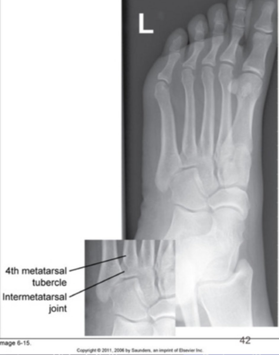 <p>Lateral cuneiform slightly superimposed on cuboid</p>