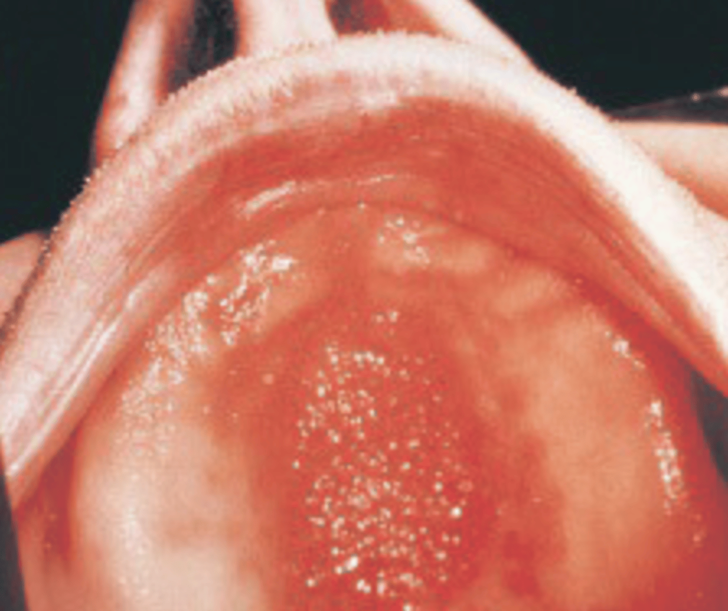 <p>an ill-fitting suction area of a maxillary denture</p>