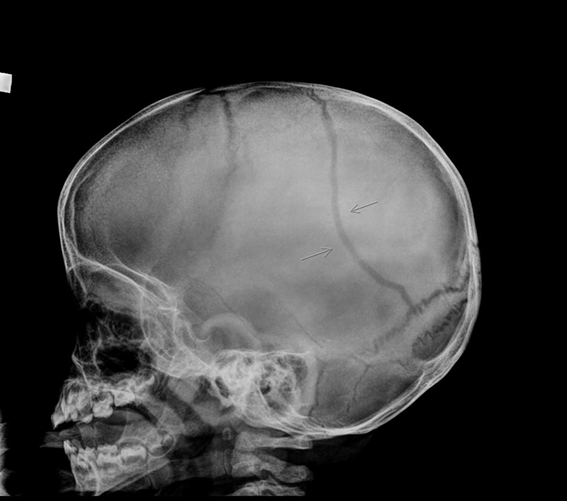 <p>subdural hematoma, skull fracture, epidural hematoma, or aneurysm</p>