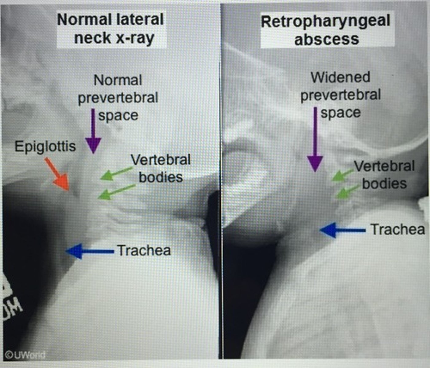 <p>Retropharyngeal abscess (RPA)</p><p>= CT scan w/ contrast</p><p>- > polymicrobial</p>