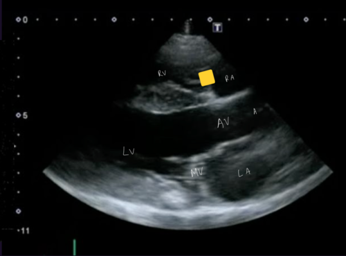 <p>Right parasternal 5 chamber view</p>