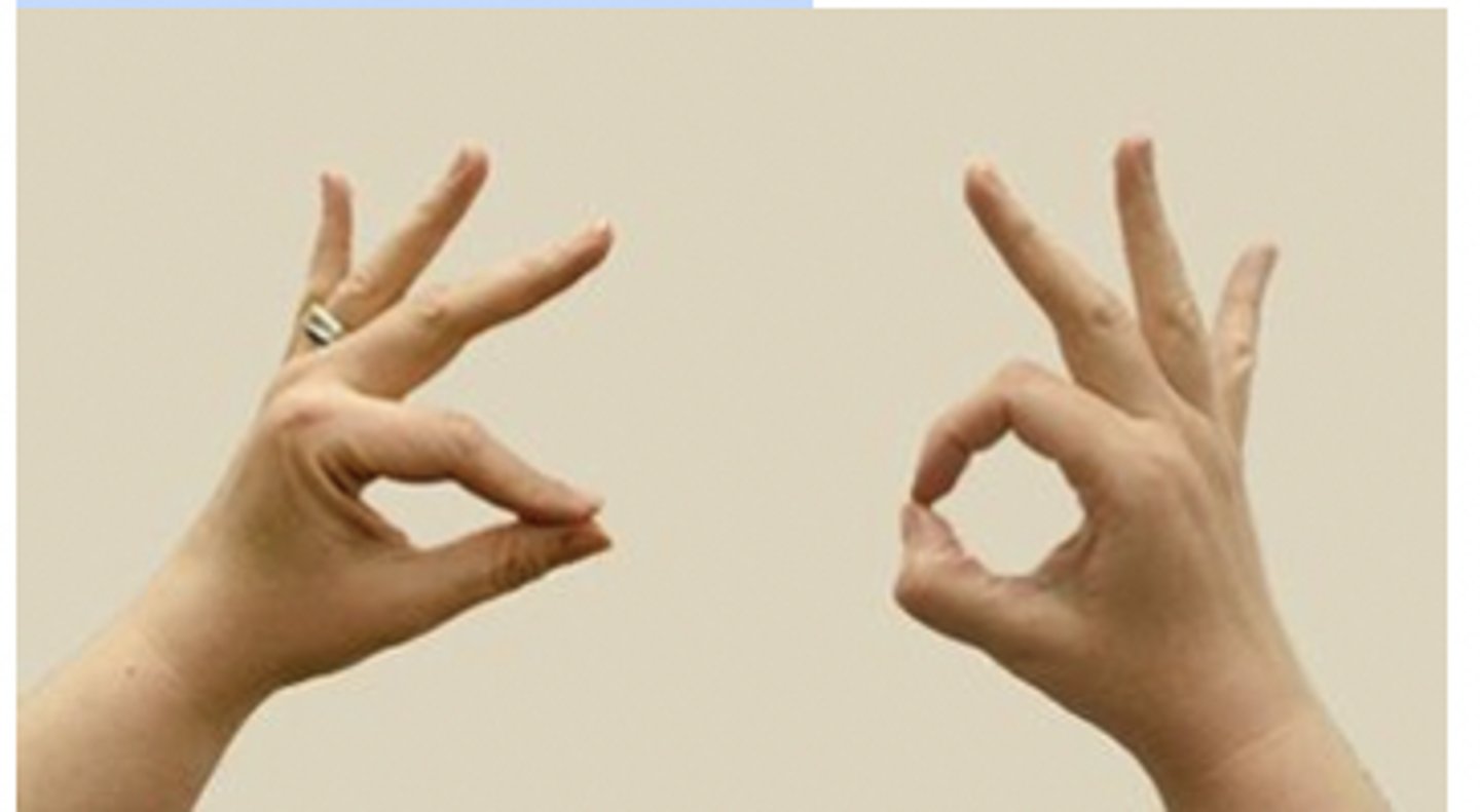 <p>Rationale</p><p>1. The image shows an anterior interosseous syndrome (Kiloh-Nevin syndrome) in the patient's left hand. The patient is unable to flex the distal phalanx of the thumb and index fingers (1st and 2nd digits) because the anterior interosseous nerve, which supplies the flexor pollicis longus and the radial half of the flexor digitorum profundus, is entrapped. (p. 411)</p><p>2. With entrapment of the radial nerve, all extensor muscles of the forearm would be affected (p. 416). The image shows a deficit in the pinch of the thumb and index finger (1st and 2nd digits).</p><p>3. Entrapment of the posterior interosseous nerve results in functional wrist drop (p. 416). The image shows a deficit in the pinch of the thumb and index finger (1st and 2nd digits).</p><p>4. When the ulnar nerve is affected, the patient cannot fully adduct the little finger (5th digit) and hold the finger abducted and extended (p. 415). The image shows a deficit in the pinch of the thumb and index finger (1st and 2nd digits).</p>