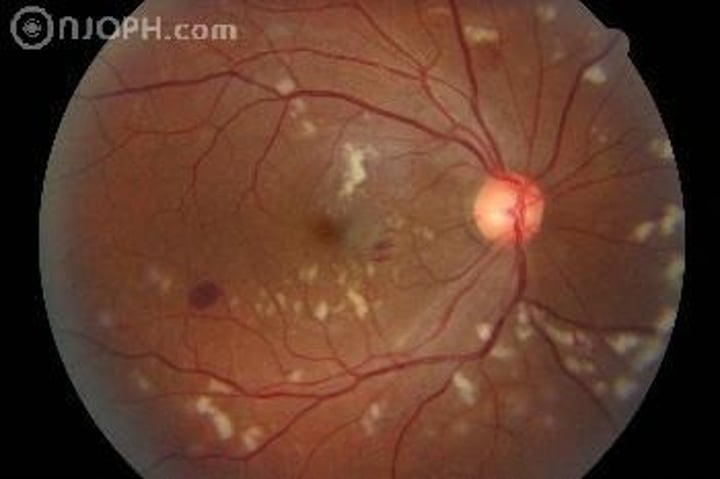 <p>may develop following tx of intraocular tumors by plaque therapy(bracytherapy) or external beam irradiation<br>-can also occur with any radiation to head and neck<br>-dose dependent (6mo-3yrs after) endothelial cell damage w microvascular changes/capillary occlusion<br>*<b>looks like diabetic retinopathy</b>*<br>Mgmt: Anti-VEGF/Steroid for ME, PRP for neo</p>