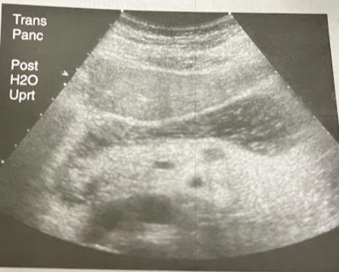 <p>A 41 year old obese woman presents in acute distress. The family member accompanying her reports that her initial symptoms were mild and included hunger and anxiety. Earlier in the day, she began to have what appears to have been seizures. Imaging studies are ordered, the sonogram reveals a small hypoechoic lesion that measures approximately 1cm. Discuss the pt hx and likely reason for sonographic finding. </p>