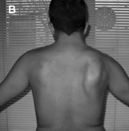 <p>Spinal Accessory Nerve Palsy MOI</p>