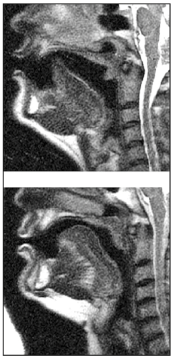 <p>Vowels produced with the tip of the tongue raised or the tongue in a high bunched position, resulting in an r-colored sound. In both there is a constriction in the pharynx caused by retraction of the part of the tongue near the epiglottis.</p>
