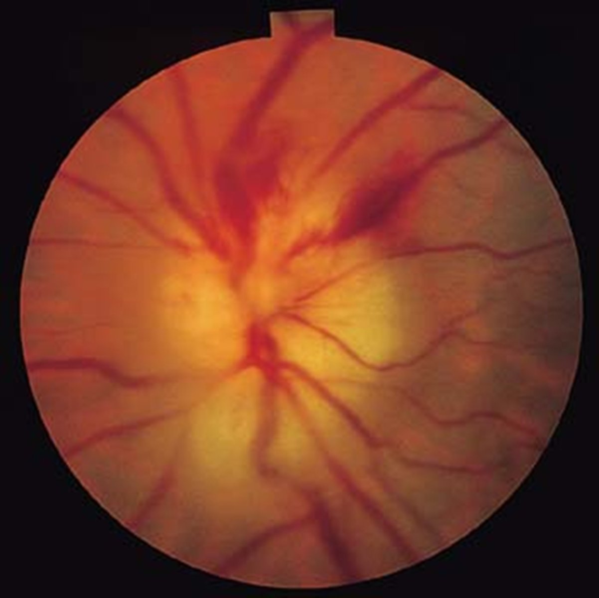 <p>What are some S/S of <strong>GCA</strong>?</p>