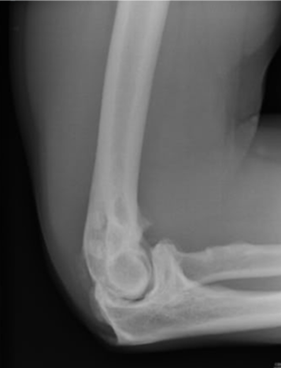 <p>What is osteoarthrosis of the elbow secondary to?</p>