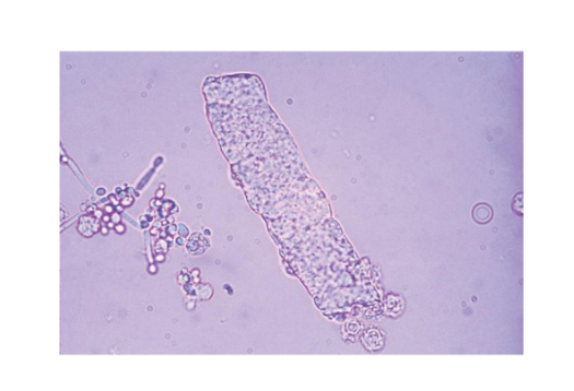 <p><span style="font-family: Arial, sans-serif">Waxy Casts</span></p>