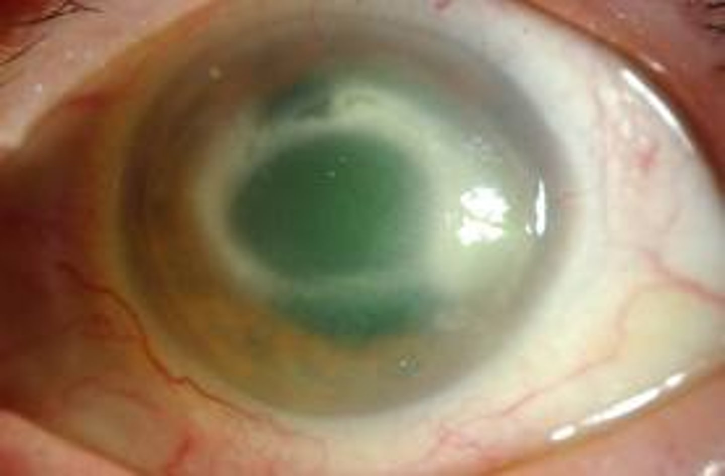 <p>Amoeba transmitted via water and soil</p><p>Associated with unsanitary contact lenses</p><p>May require a corneal transplant</p>