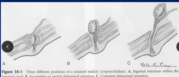 <p><span style="background-color: transparent;"><strong>Cryptorchidism</strong></span></p>