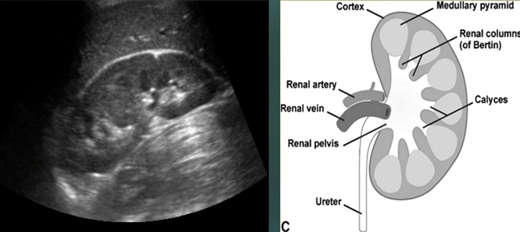 <p>Normal calyces </p>