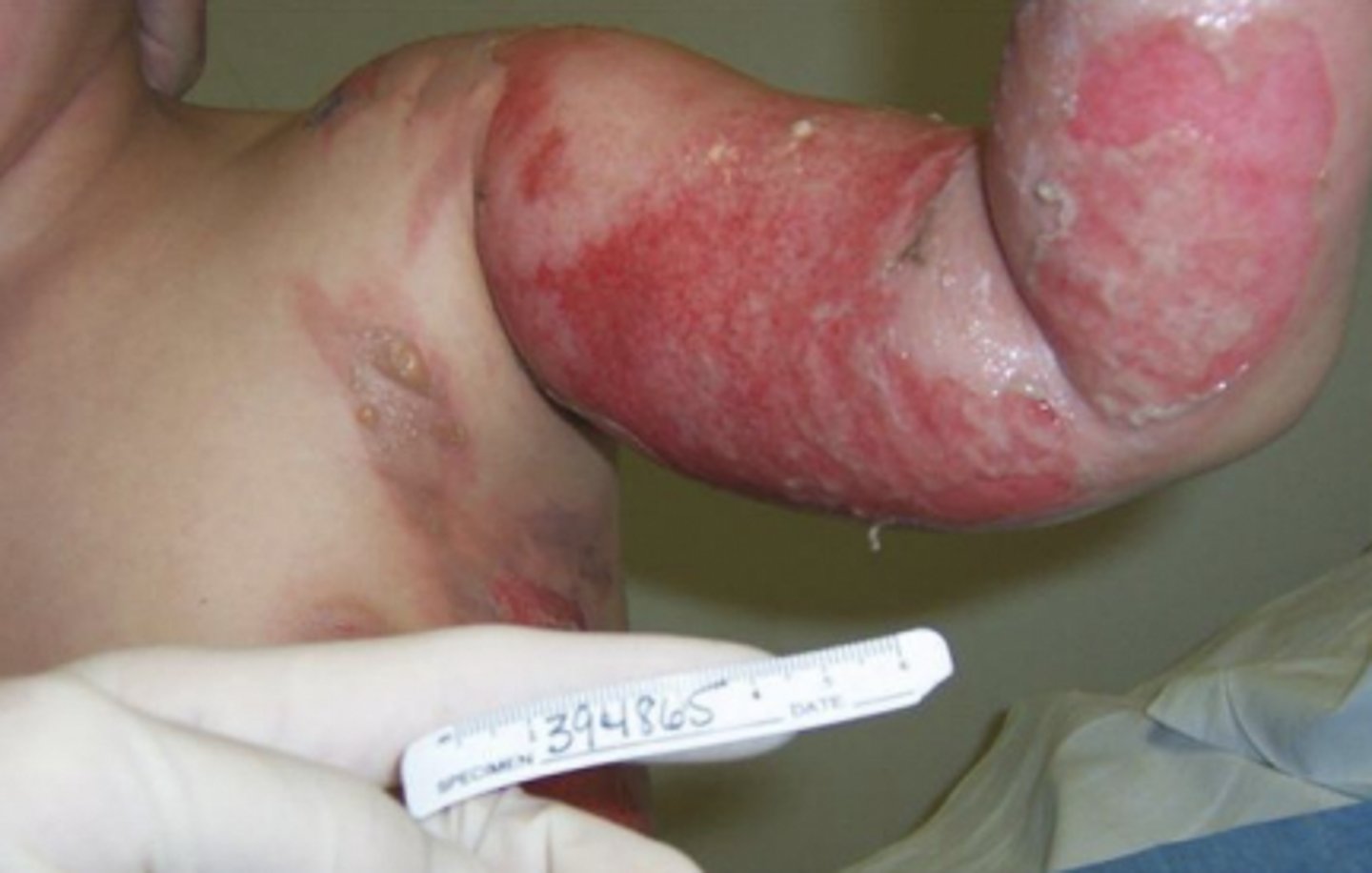 <p>Integumentary, CV changes, Renal/GI changes, Pulmonary artery hypertension & immune system suppression</p>