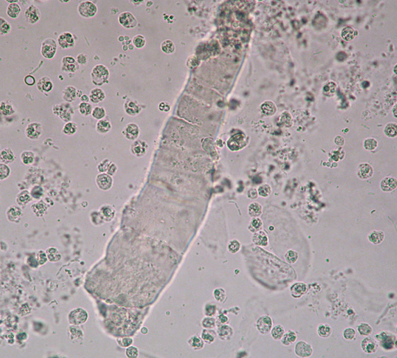 <p>Final degenerative form of all types of cast</p><ul><li><p>Brittle and w/ jagged ends</p></li><li><p>“Chronic Renal Failure”</p></li></ul><p></p>