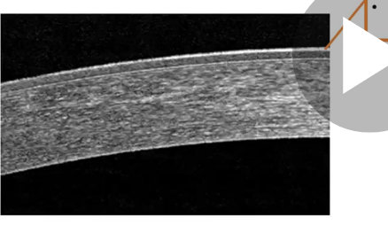 <p>corneal epithelium </p>