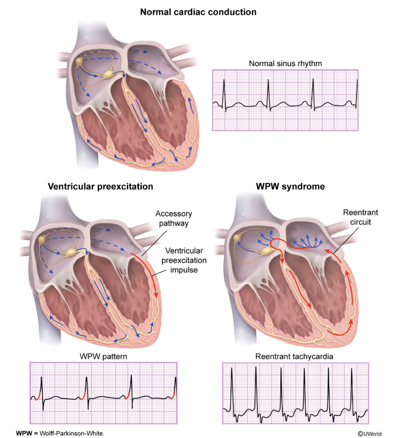 <p>WPW Syndrome </p>