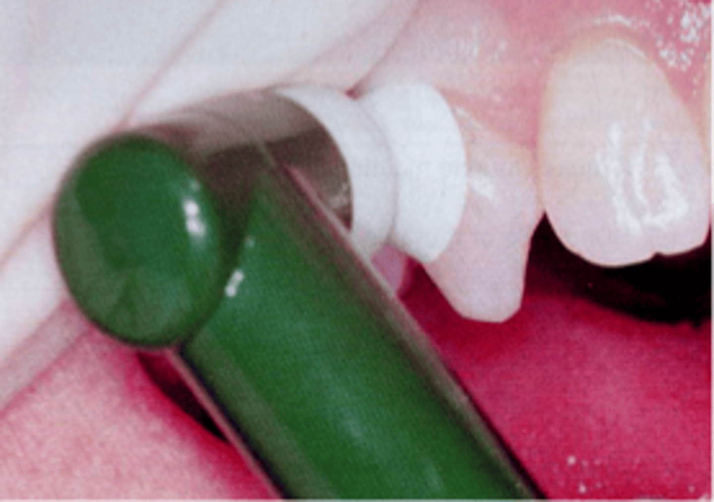 <p>1) Explain procedure to patient</p><p>2) Give pre-procedural rinse</p><p>3) Apply paste to tooth surfaces</p><p>4) Start low speed</p><p>5) Adapt rotating cup to tooth surface</p><p>(<strong>Flare</strong> cup on tooth surface)</p><p>6) Adapt cup to cervical area</p><p>(Cup flared under gingival margin, Apply light pressure to flare edges out and into sulcus)</p><p>7)Proceed across cervical</p><p>8)Polish incisal or occlusal portions</p>