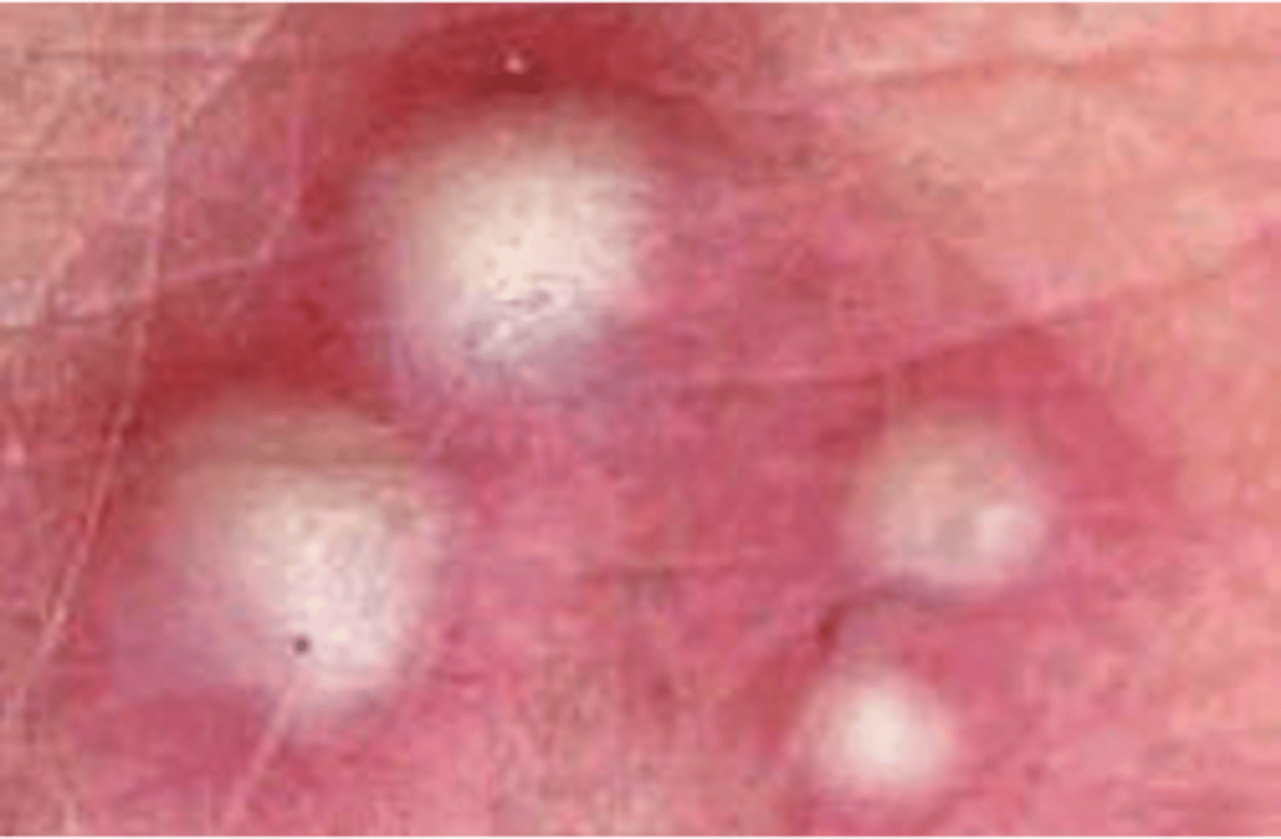 <p>•A vesicle or bulla containing purulent fluid is known as a _________</p>