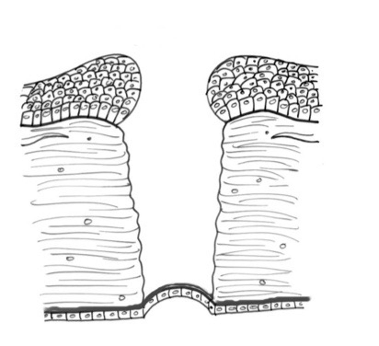 <p>Describe what type of cornea ulcer is happening here, where the deepest layer is exposed?</p>