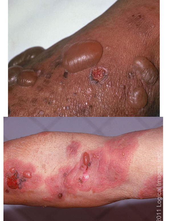 <ul><li><p>prodromal: wks/mos of pruritic eczematous papular or urticaria like skin lesions</p></li><li><p>1-3 cm bulla on erythematous, urticarial, noninflammatory base; blisters may be numerous and widespread</p></li><li><p>pruritus</p><ul><li><p>location: trunk, extremity flexures, axillary/inguinal folds, oral mucosa, larynx, genital and anus</p></li></ul></li></ul><p></p>