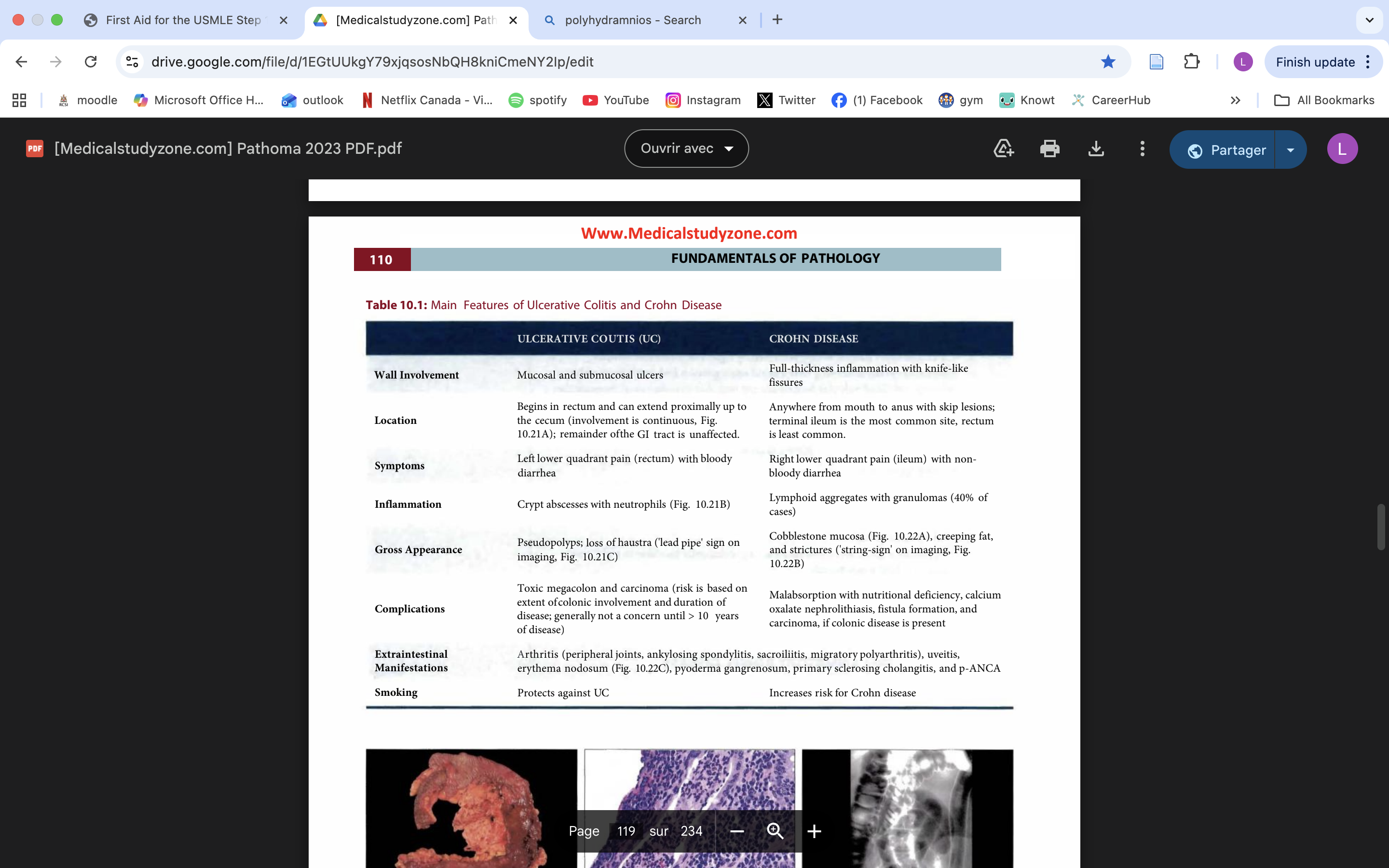 <p>chronic relapsing</p><p>potentially due to abnormal immune response to enteric flora</p><p>young women</p><p>UC vs CD</p>