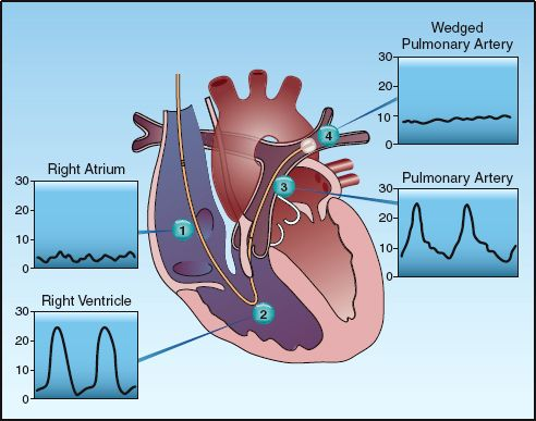 <p>found when a pulmonary catheter with an inflated balloon is wedged into a pulmonary arterial branch</p><ul><li><p>indirect LA pressure measurement</p></li></ul><p></p>