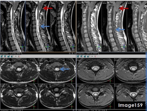 <p>The pathology identified by the blue arrows in Image 159 is a syrinx, displaying T1 _____________ signal and T2 _______________ signal relative to the spinal cord.</p>