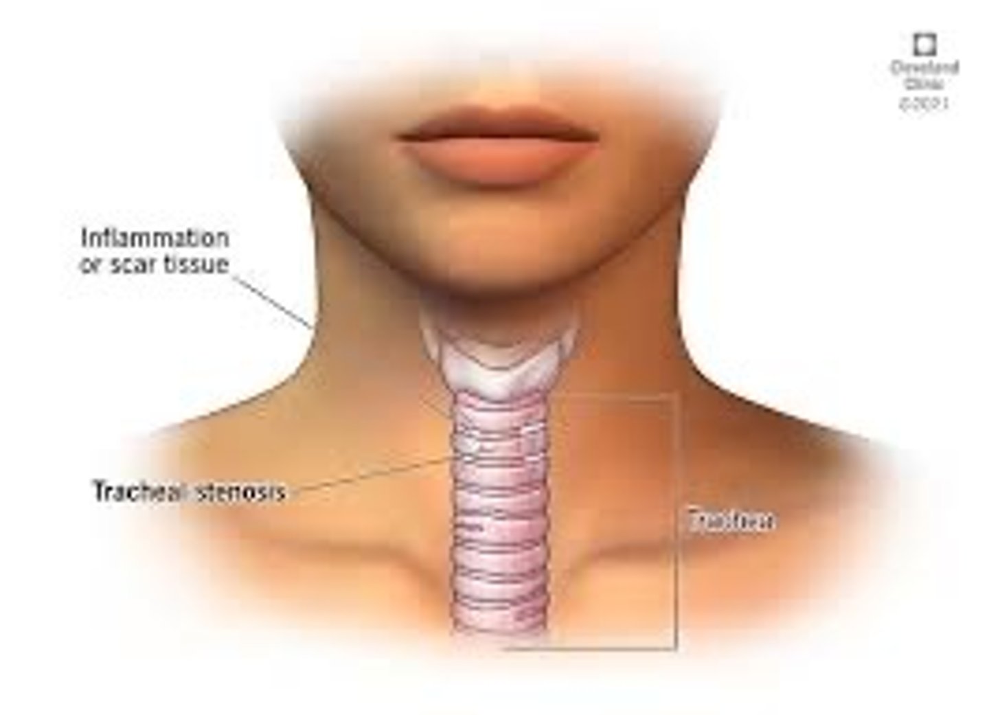 <p>Main pipe that goes down into lungs-has cartilage rings.</p>