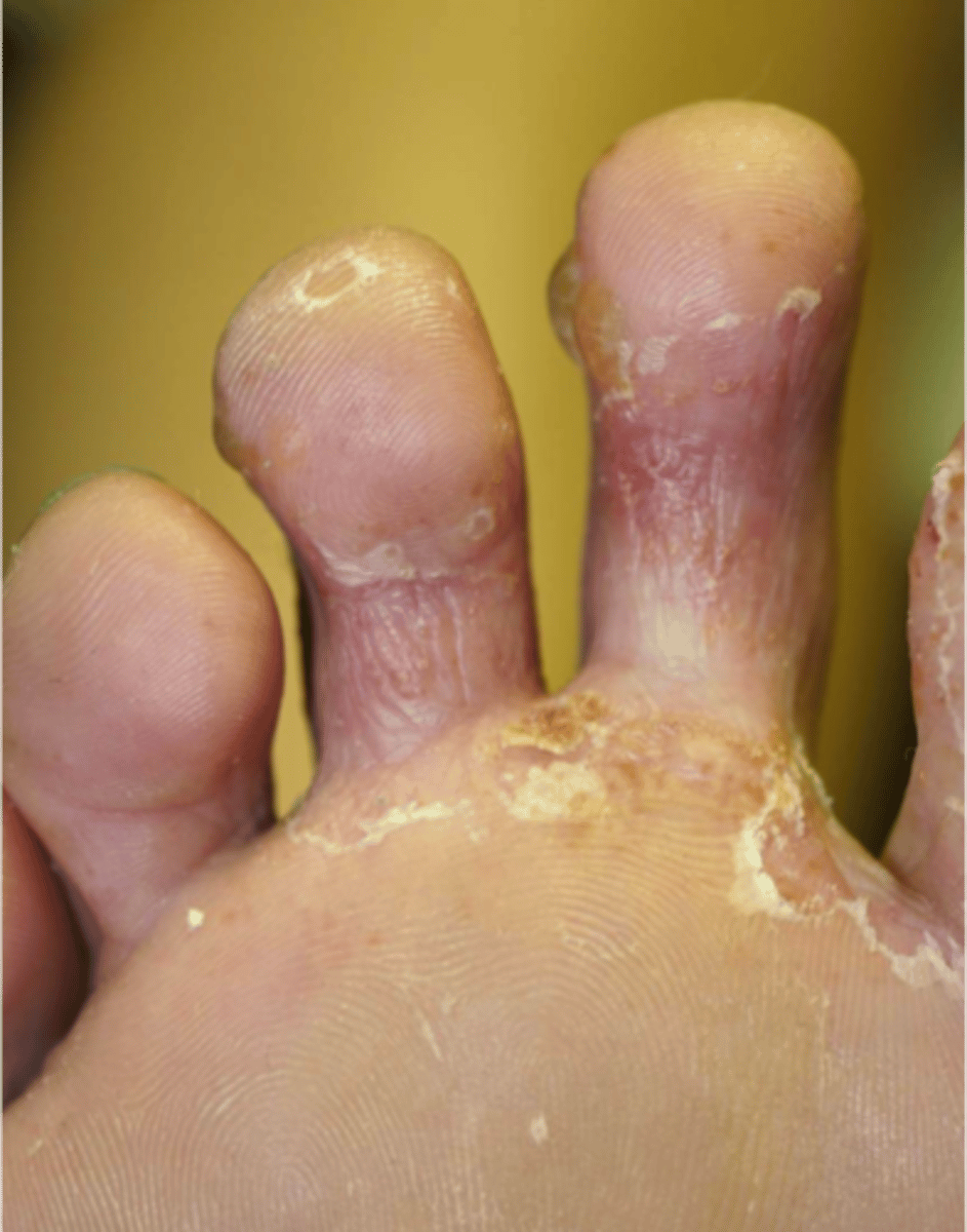 <p>-tinea pedis (fungus)</p><p>-peeling, itchy feet</p><p>-treat with topical anti-fungals</p>