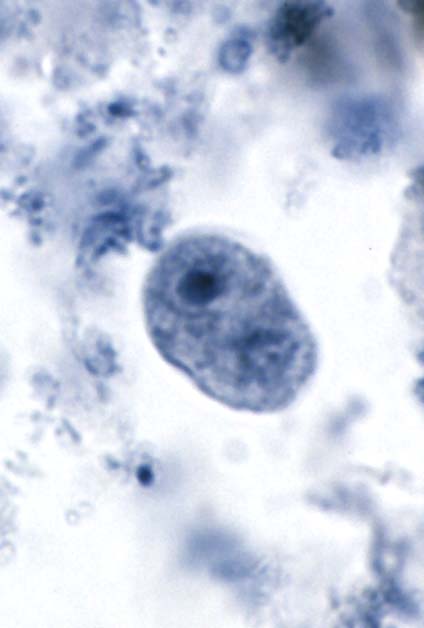 <ul><li><p>6-20 um</p></li><li><p>no peripheral chromatin</p></li><li><p>achromatic granules around large karyosome </p></li><li><p>vacuolated cytoplasm</p></li></ul><p></p>