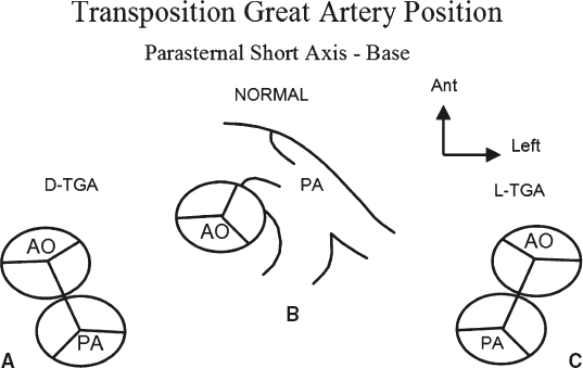 <p>Ventriculo-arterial discordance in which the aorta arises from the right ventricle and the pulmonary artery from the left ventricle, creating parallel circulations.</p>