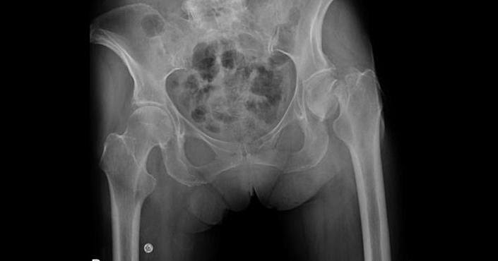 <p>Bony fragment is wedged into another fragment. Common in hip and shoulder fractures</p>