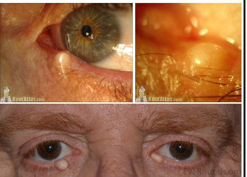 <p>Cyst lined by keratinized epithelium of epidermis and filled with <strong><u>liberated keratin often associated with a hair follicle</u></strong></p>