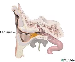<p>buildup of earwax that blocks the ear canal causing decreased hearing and inability to visualize the tympanic membrane.</p>
