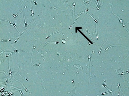<ol><li><p>Identify pointed structure.</p></li><li><p>What reagent strip parameter may be positive when a lot of this structure is found in patient’s sample?</p></li></ol><p></p>