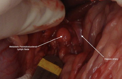 <p>1. acute management of hypoglycemia</p><p>2. exploratory laparotomy</p><p>3. medical therapy</p>