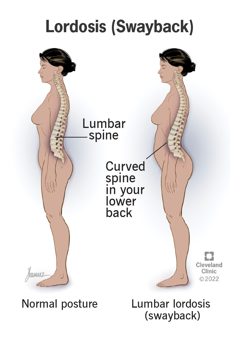 <ul><li><p><strong>Exaggerated inward (convex) curvature of the lumbar spine</strong></p></li><li><p>cause by </p><ul><li><p>Obesity, </p></li><li><p>tuberculosis of the spine</p></li><li><p>poor posture</p></li><li><p>pregnancy, osteoporosis, </p></li><li><p>continual wearing of high heels</p></li></ul></li><li><p>Mild to moderate pain</p></li><li><p>Preventing or treating the underlying cause</p></li></ul><p></p>