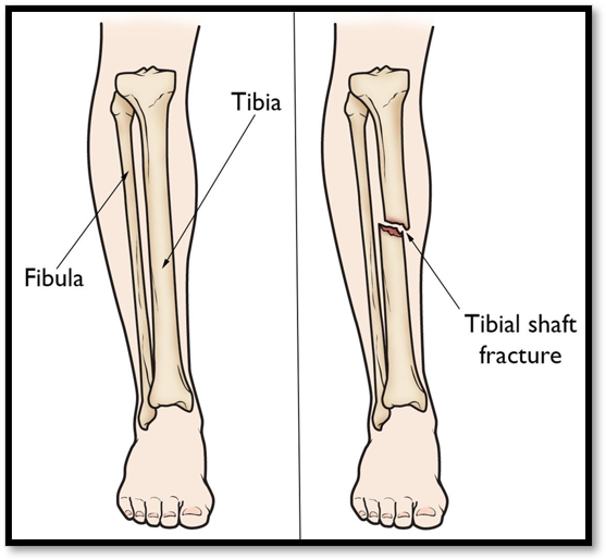 <p><span>•Occurs with a strong force, common site of stress fractures</span></p><p><span>•</span><strong><u><span>Signs/Symptoms: </span></u></strong><span>soft tissue damage, devascularization, open fracture</span></p><p><span>•</span><strong><u><span>Complications: </span></u></strong><span>Compartment syndrome, fat embolism, infection if open fracture&nbsp;&nbsp;&nbsp; </span></p><p><strong><u><span>Diagnostic:&nbsp; </span></u></strong><span>Xray</span></p><p><span>•</span><strong><u><span>Treatment: </span></u></strong><span>closed reduction with immobilization in a long leg cast</span></p><p><span>•</span><strong><u><span>Nursing care: </span></u></strong><span>assess affected extremity every 2 hours, perform ROM, non-weight bearing for 6-12 weeks, educate on proper crutch walking.</span></p>