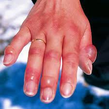 Subdermal freezing of tissues, Widespread cell death, Delineation of permanent damage, Similar to a burn, blistering
