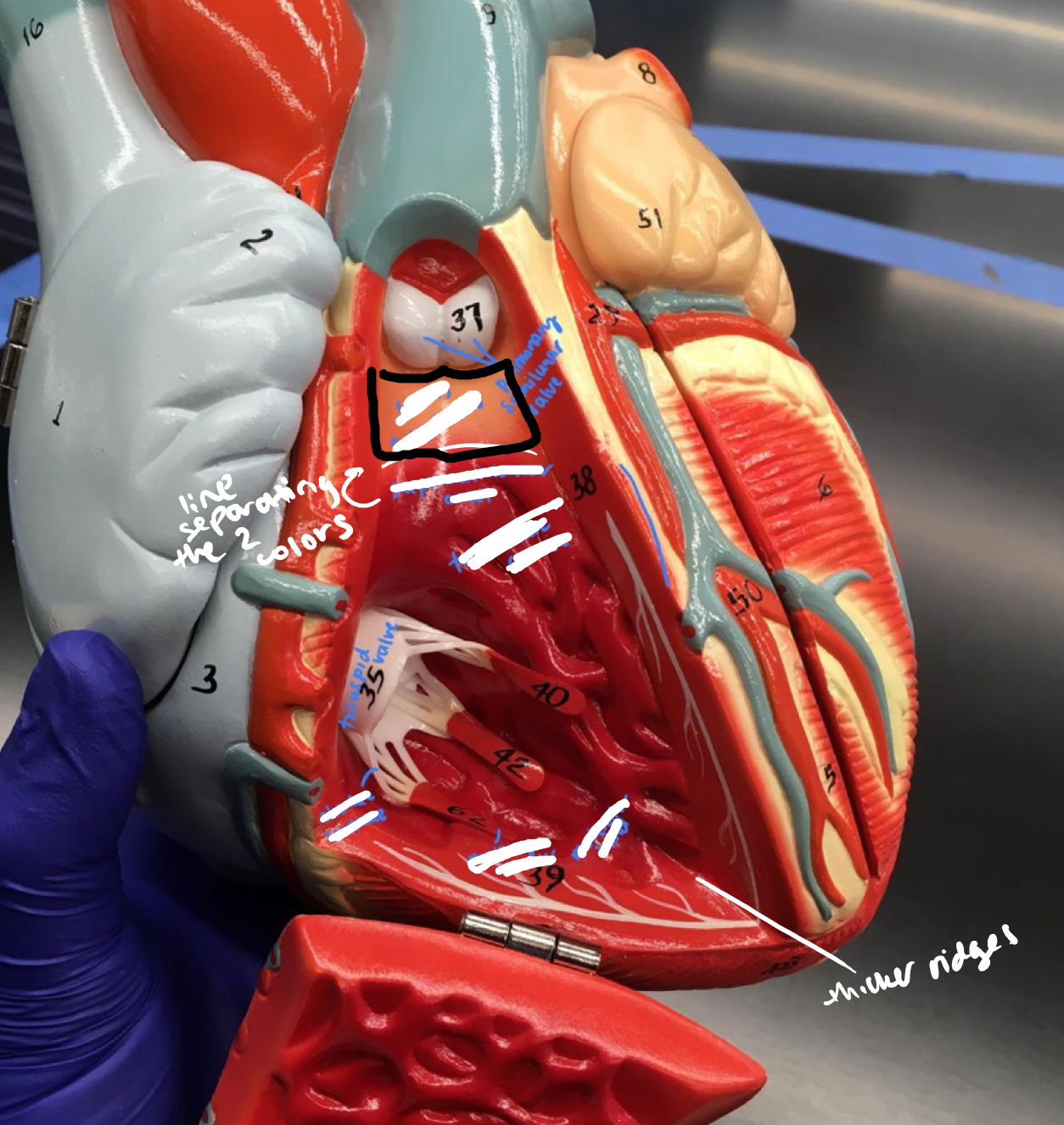 <p>The lighter orange upper part of the right ventricle, just below the pulmonary semilunar valve</p>