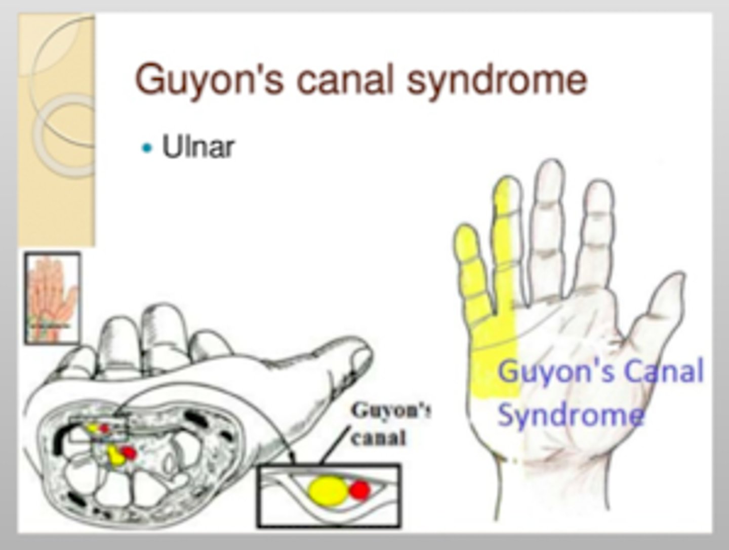 <p>space occupying lesions that entraps the ulnar nerve</p><p>- includes: tumor, lipoma, ulnar artery aneurysm and muscle anomaly</p>