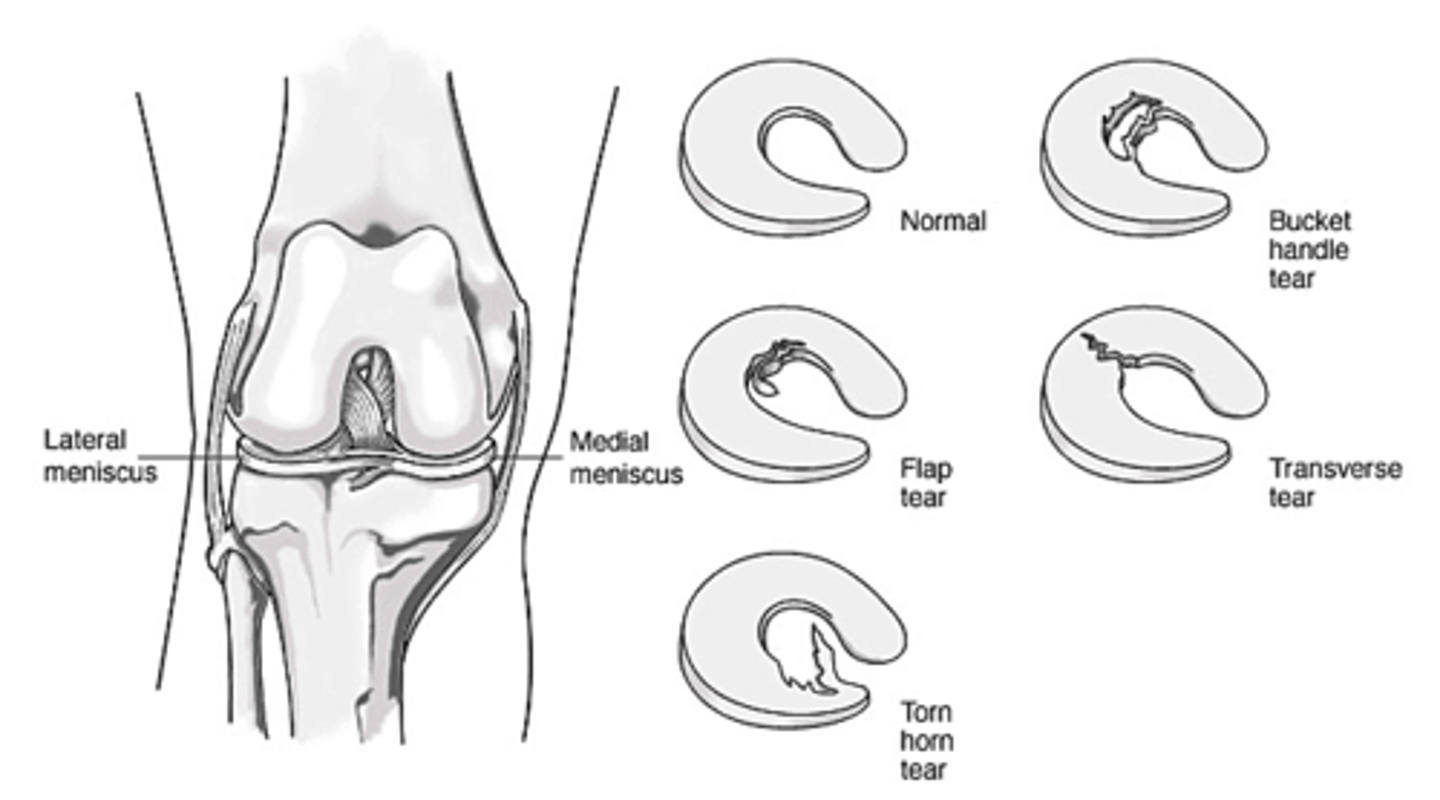 <p>Meniscal tear</p>