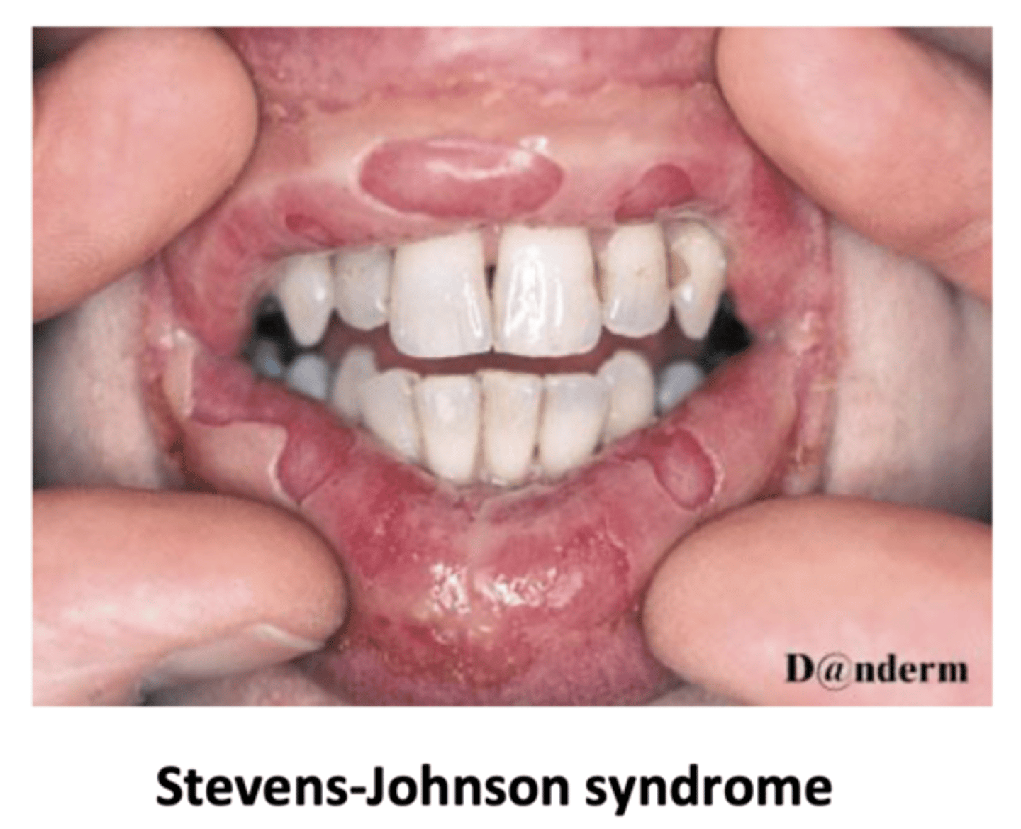 <p>mucocutaneous necrosis with at least two mucosal sites involved.</p><p>SJS is when there is <10% pf the body area affected</p><p>(SJS-TEN is a spectrum)</p>