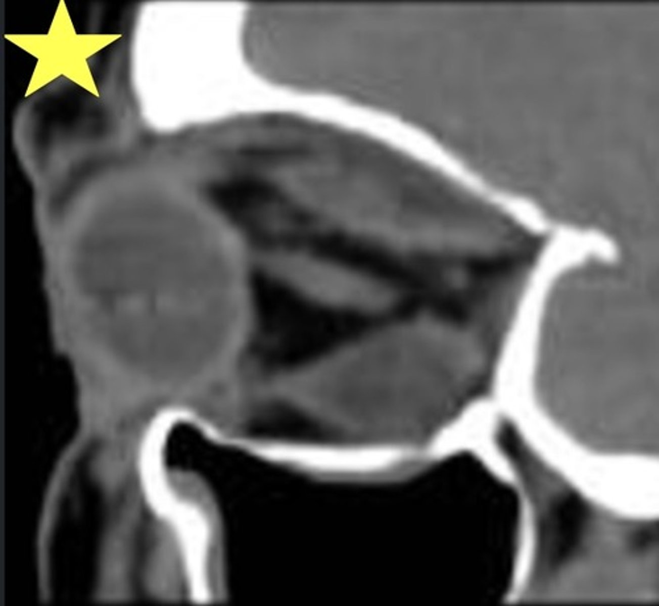 <p>Identify the radiographic abnormality. (Note enlargement of EOM bellies with sparing of insertions)</p>