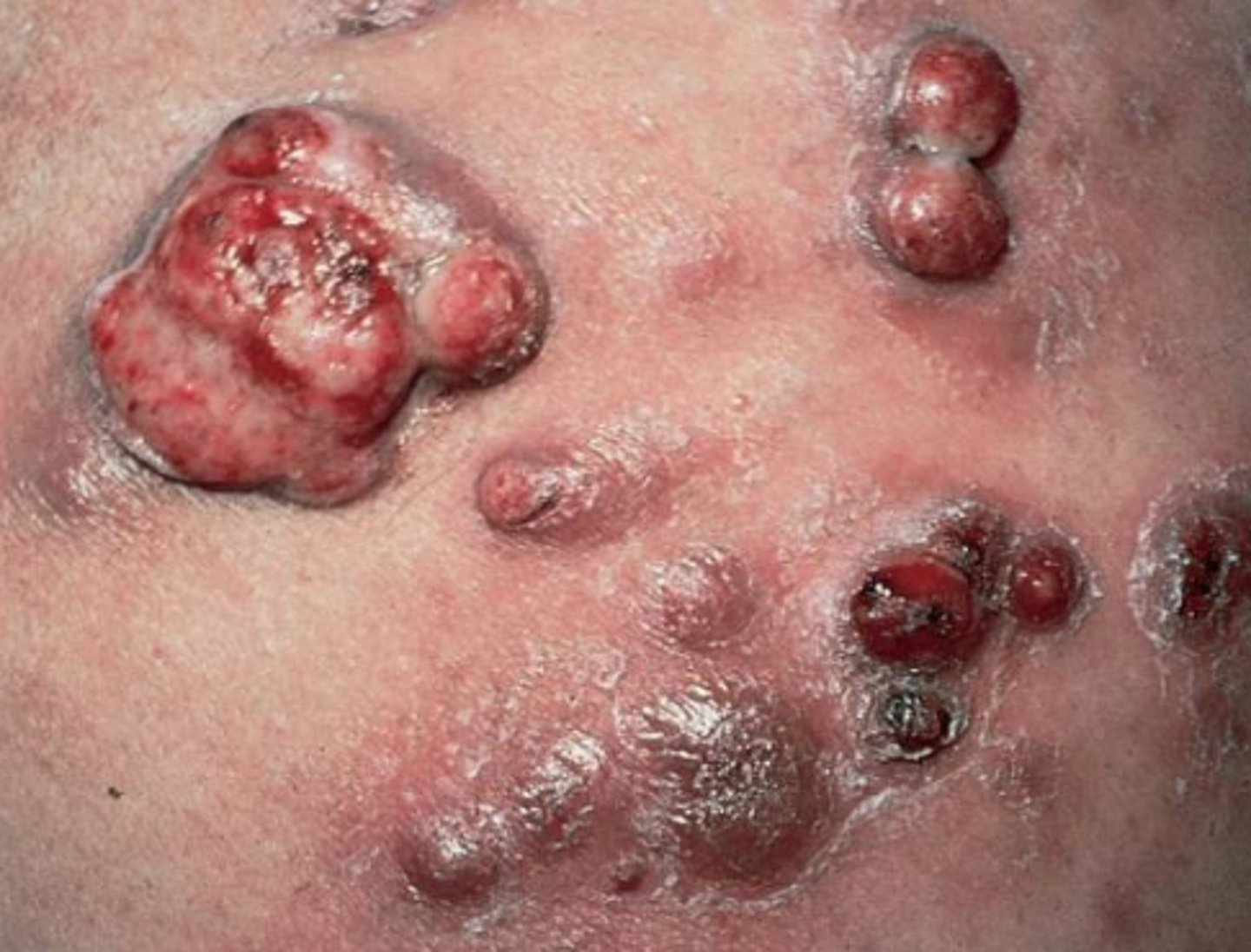 <p>this complication of bartonella henselae primarily presents in AIDS pts</p>