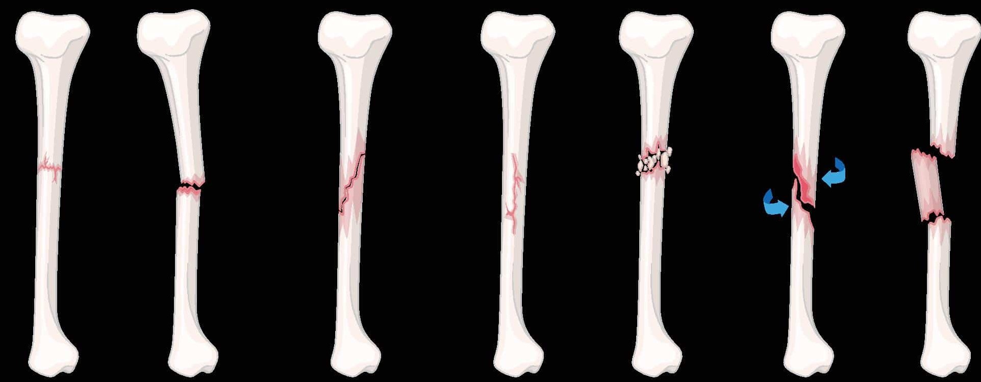 broken bone (6-8 weeks to heal, good circulation)
